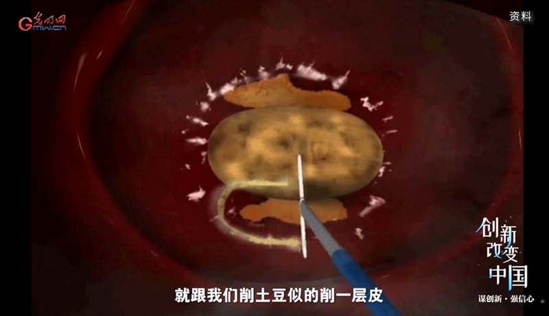 宫颈癌消灭战:如何减少“梅艳芳式悲剧”? 宫颈癌消灭战:如何减少“梅艳芳式悲剧”?(图6)